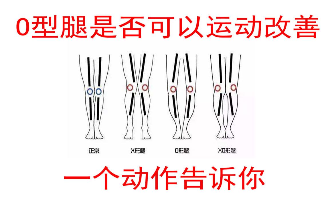 【你是哪种O形腿】不是所有的O型腿都能通过运动矫正