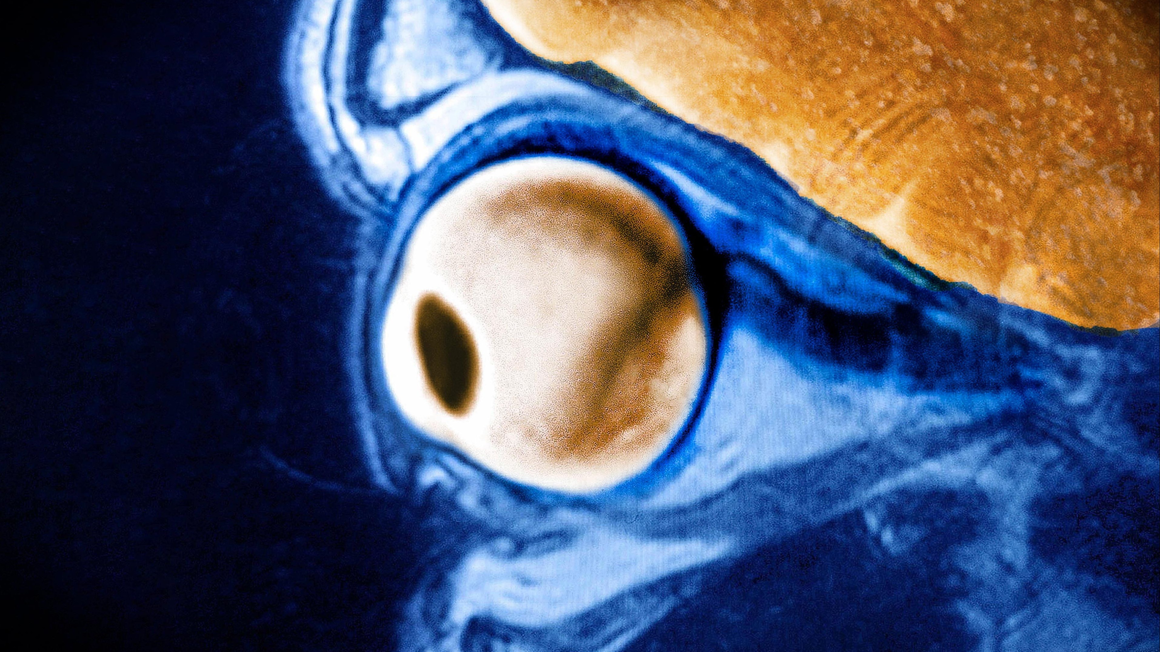 一个小男孩在7年里每天吃掉75个鸡块，这是他的眼睛发生的变化