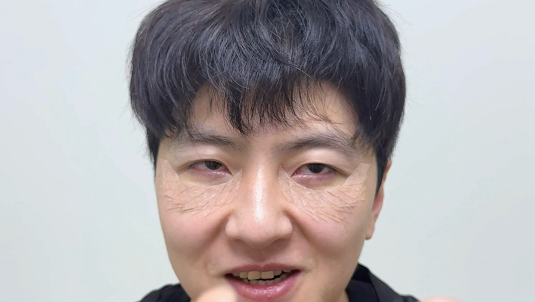 眼袋后续来了