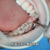 智齿一定要拔吗？怎么拔智齿,请看智齿拔除术，胆小勿入