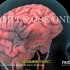 【3D医学动画】出血性脑卒中（中风）