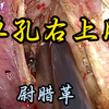 单孔胸腔镜右肺上叶癌根治术原速未剪辑 解说版 尉腊革教授供稿