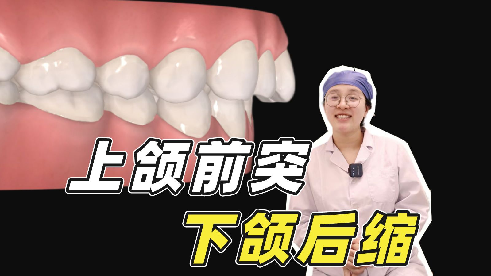 【上海九院】上颌前突+下颌后缩，成年后还可以矫正吗？
