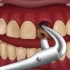 牙齿烂的只剩残根 （种植牙全过程）
