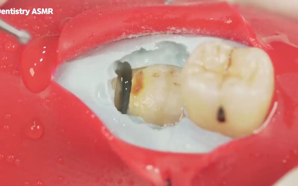 如何看待：牙科医生模拟拔智齿全过程， 感觉治愈又疼痛[1次更新]的第1张示图