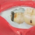 牙科医生模拟拔智齿全过程， 感觉治愈又疼痛