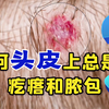为何头皮上总是长疙瘩和脓包呢？是病吗？听听医生怎么说