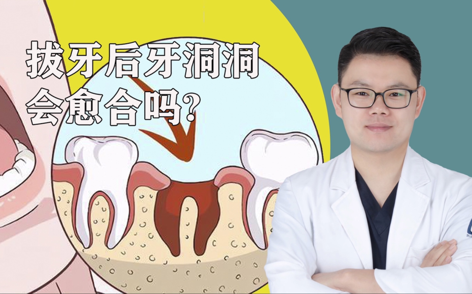 拔牙后的牙洞你知道是怎么没了的吗？