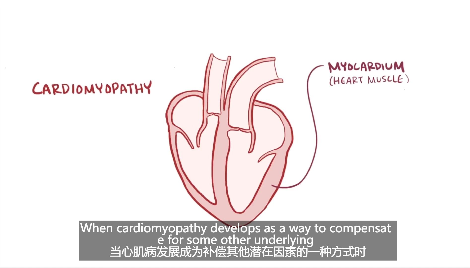 【3D医学动画】什么是扩张型心肌病（DCM）？