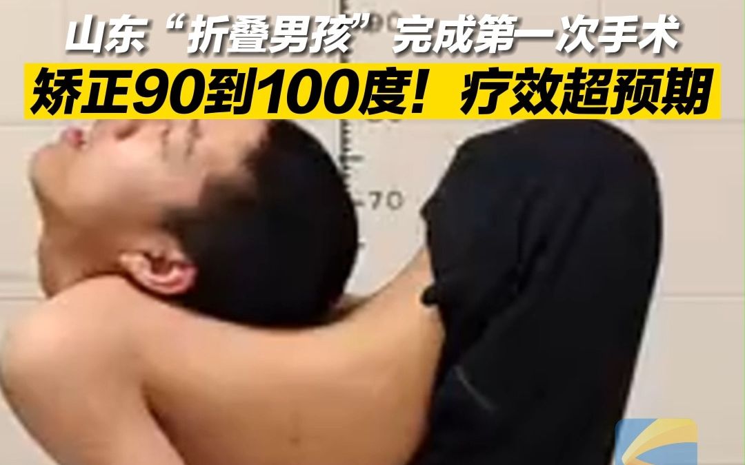 山东“折叠男孩”完成第一次手术，矫正90-100度疗效超预期