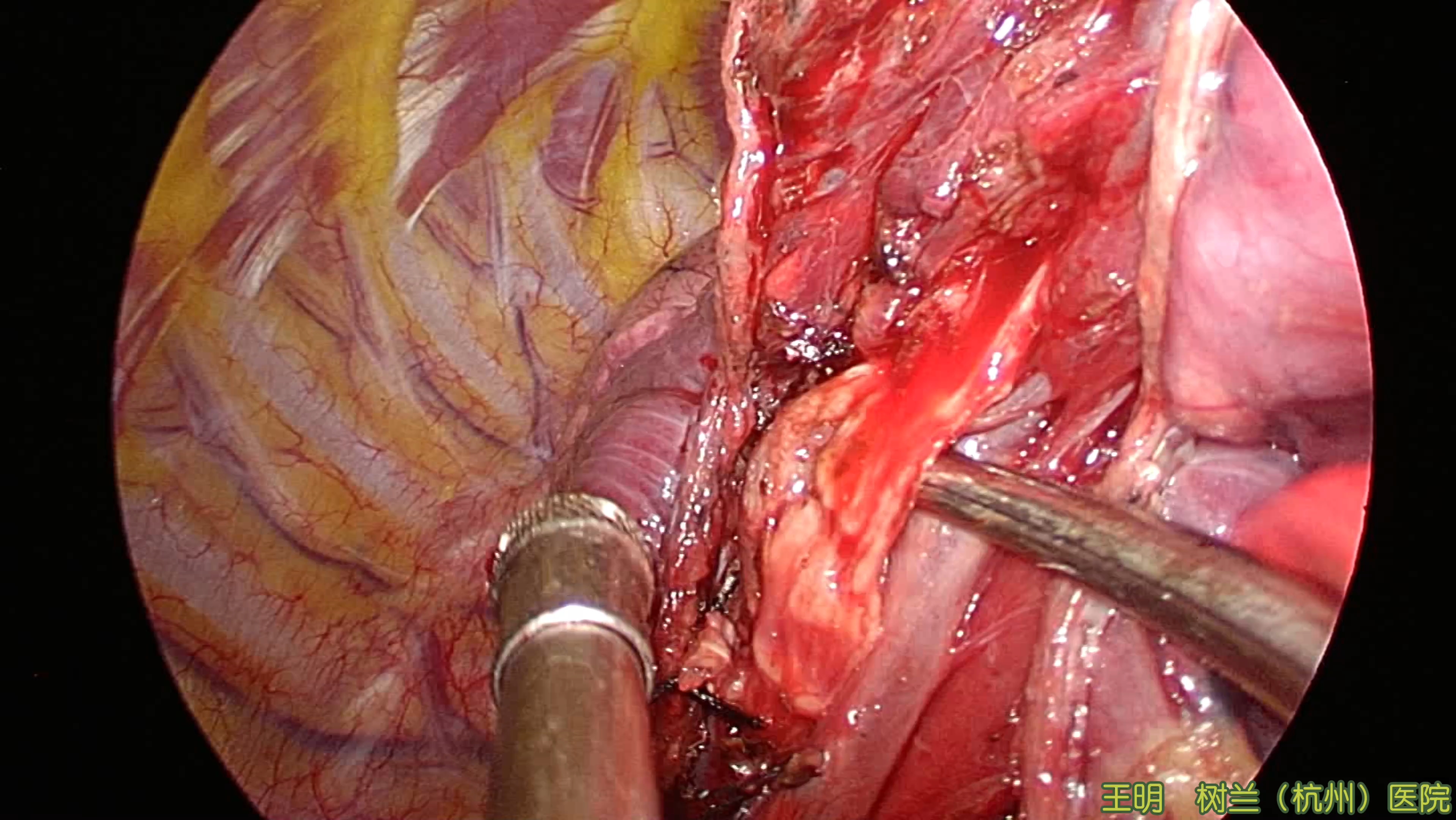 单孔右下肺外后基底段切除术（二次手术 右肺动脉干预阻断）4K