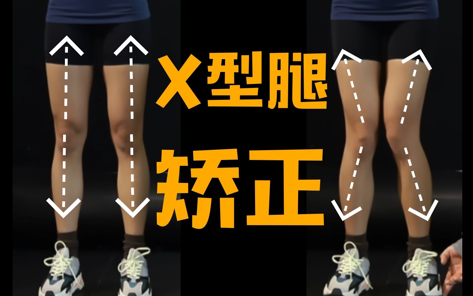 XO型腿如何靠按摩或锻炼矫正？ - 知乎