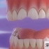 牙齿贴面的简单过程，小哔哩们看着像不像贴指甲