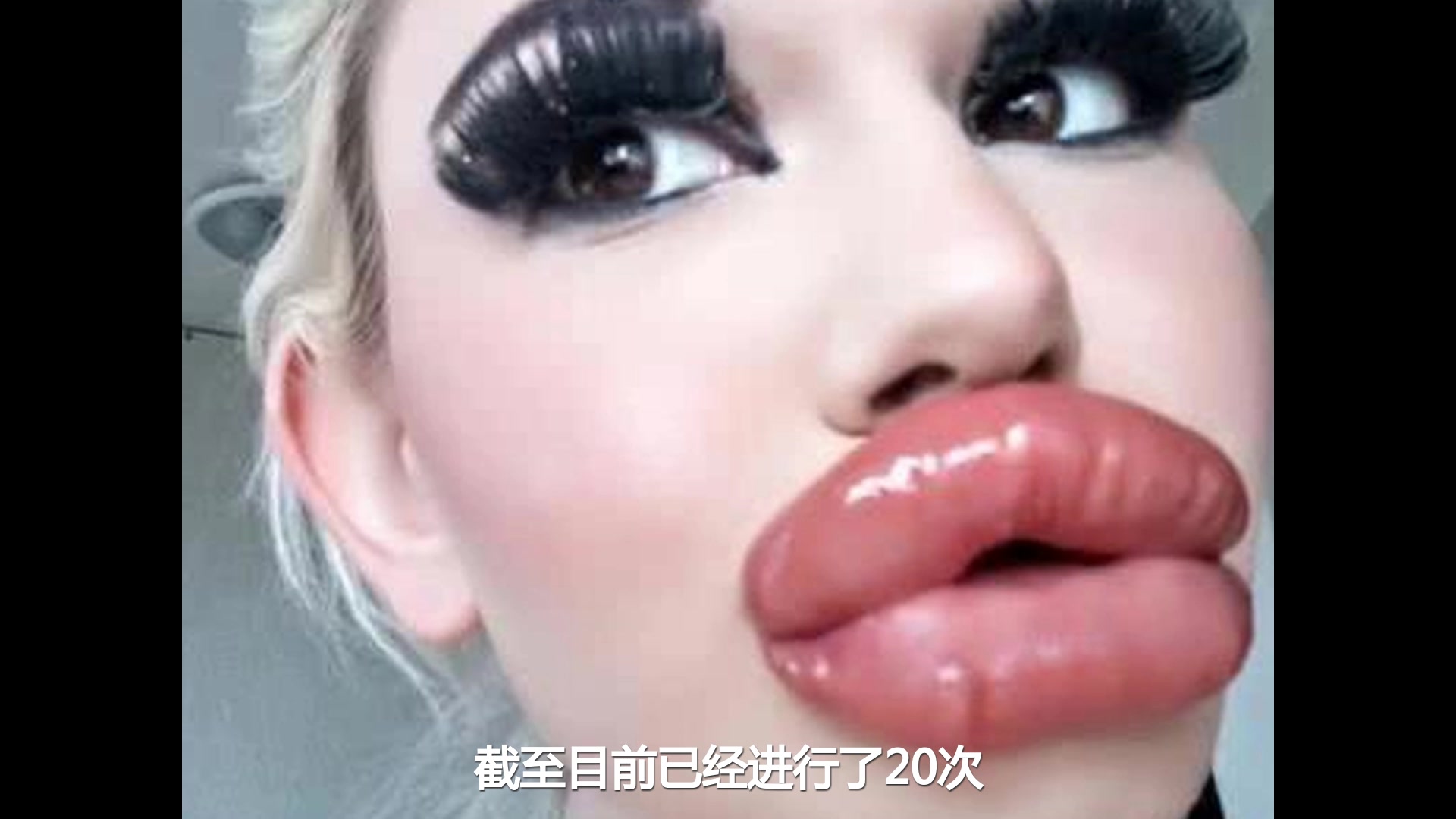 保加利亚少女想要世界最大嘴唇，丰唇20次大到合不上，仍不满足