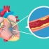 心血管疾病知识科普动画—冠心病 ，心肌梗死、 冠状动脉介入手术、心脏支架手术后恢复注意事项。