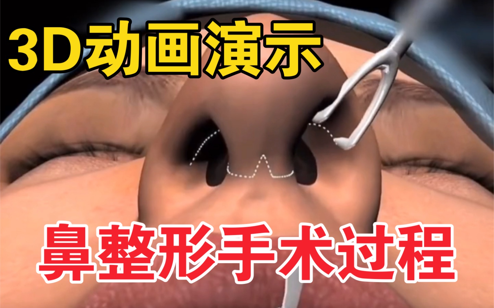 【鼻整形手术】3D动画揭秘鼻整形手术全过程，看完之后你还敢做吗？