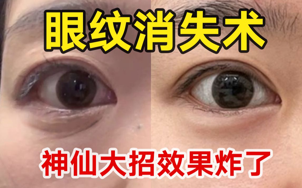 【真人实测】怎么在一个月让眼纹减少59%？