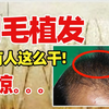 【植发科普】拿阴毛植发，会怎么样