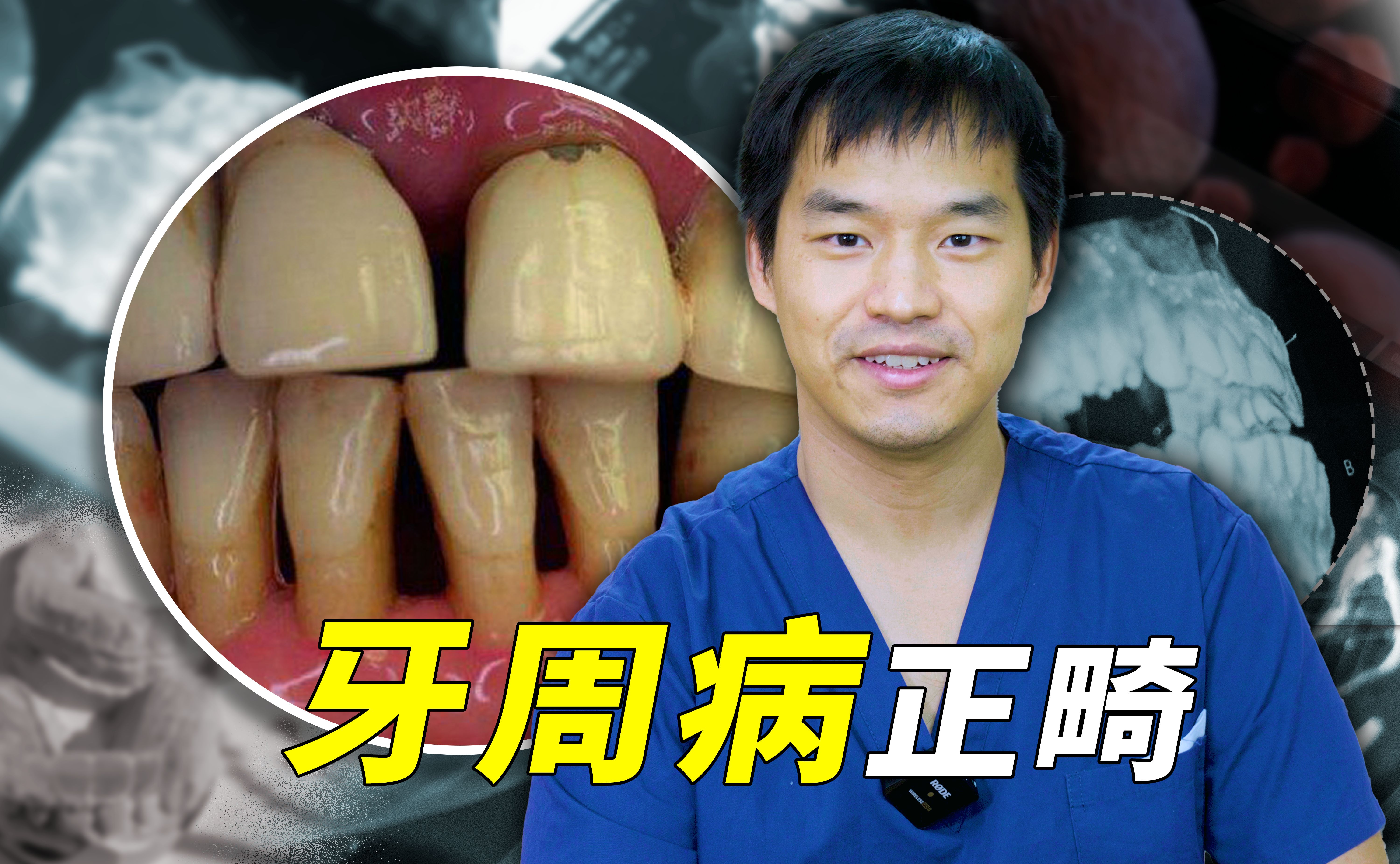 矫正牙齿前的最大挑战：牙周病如何解决！
