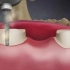 【3d动画】缺失的牙齿除了做种植牙，还能这样修复哟~