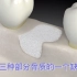 这样的种植牙需要植骨，3D动画视频带你了解三种植骨方法