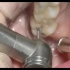以前补的银汞充填体边缘有点蛀牙了，来医院换成嵌体补牙全过程