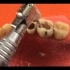 牙医是如何进行蛀牙龋齿牙齿修复的，3分钟了解操作全过程