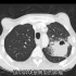 影像科肺部ct肿瘤的判断