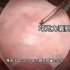 卵巢巧克力囊肿手术过程，3D演示。。