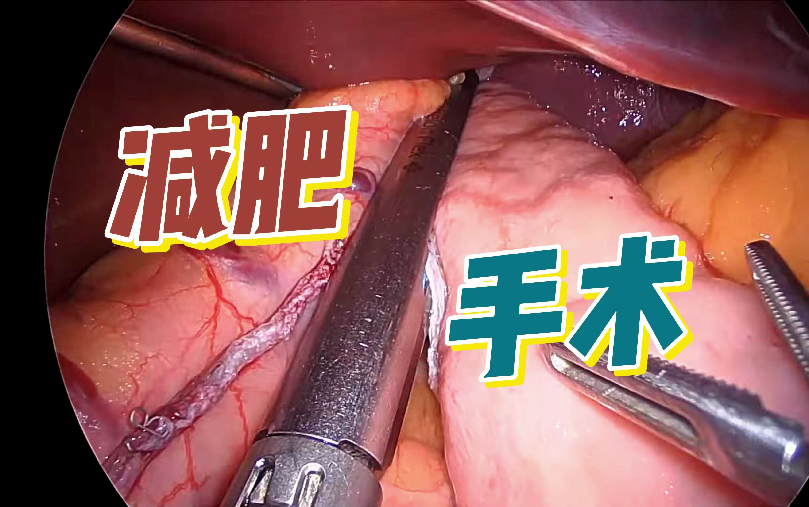 【手术】减肥手术（袖状胃切除）