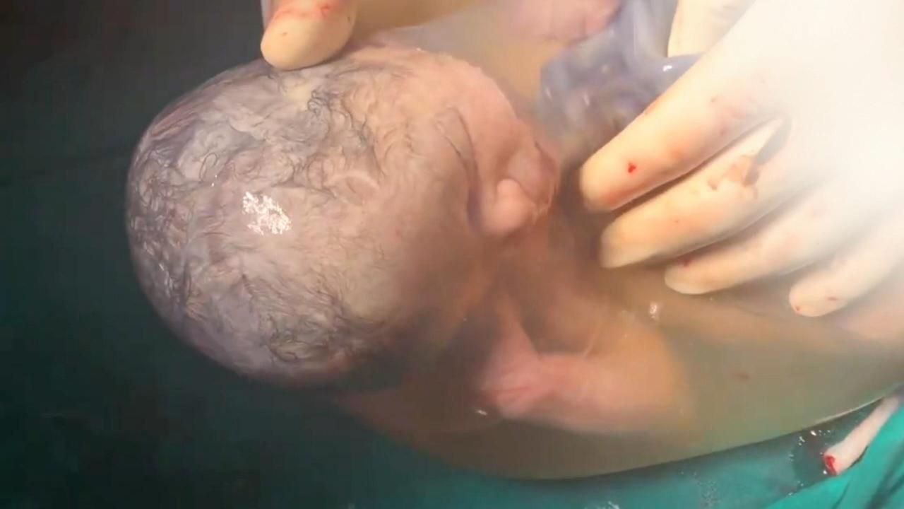 剖宫产，被羊膜包裹出生的婴儿，你一辈子可能都看不到！