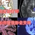 精准康复-定位诊断：脑部CT和MR的快速解读2