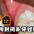 牙齿窝沟封闭补牙过程！