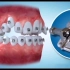 牙齿矫正3D动画演示全过程！