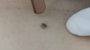 怎样快速去除牙结石土方法 d8f6cff387a332c5f91cff0220ecd6f99fa8d29f.jpg@310w_174h_1c_100q.jpg