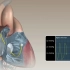 肺动脉漂浮导管动画 Swan-Ganz Catheter Placement Animation