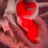 医学视频：心脏手术，减少二尖瓣反流！