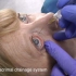 【生肉】【泪道冲洗】Syringing of lacrimal drainage system