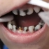 牙医高超的补牙技术，让牙齿变的好看又好用