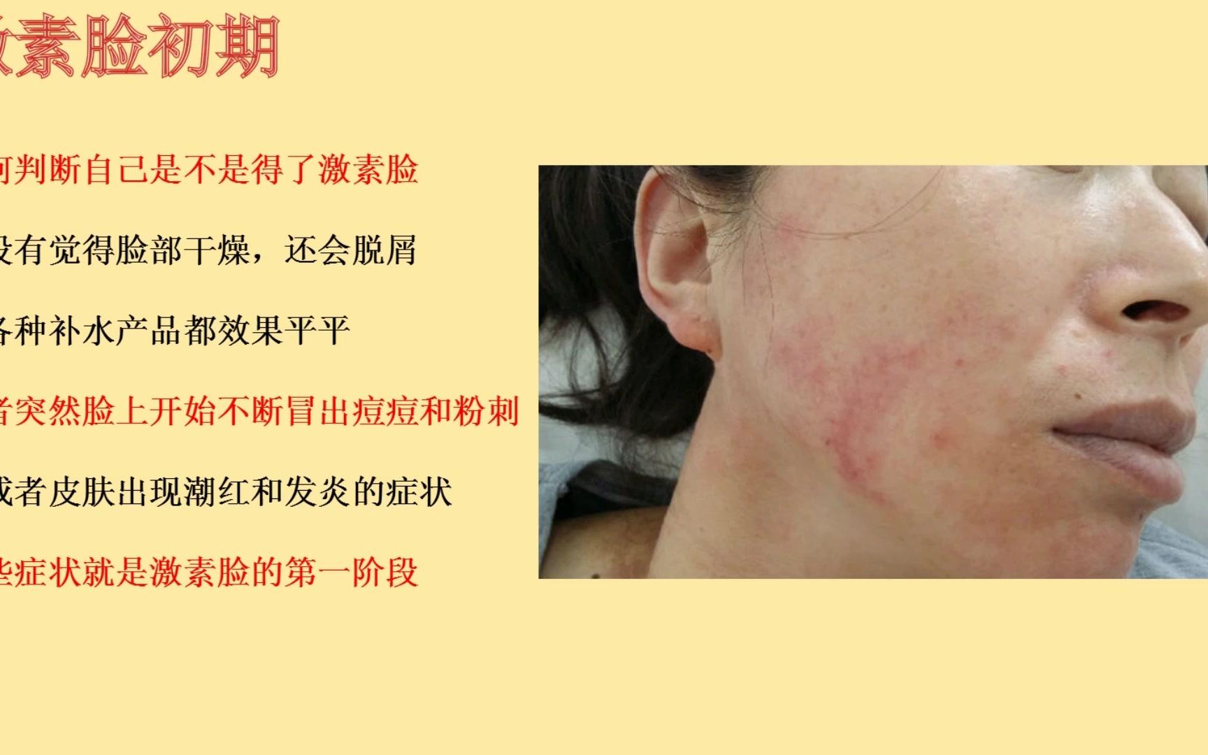 朵嘉浓宋慧激素脸的典型症状有哪些引起激素脸的原因是护肤不当还是
