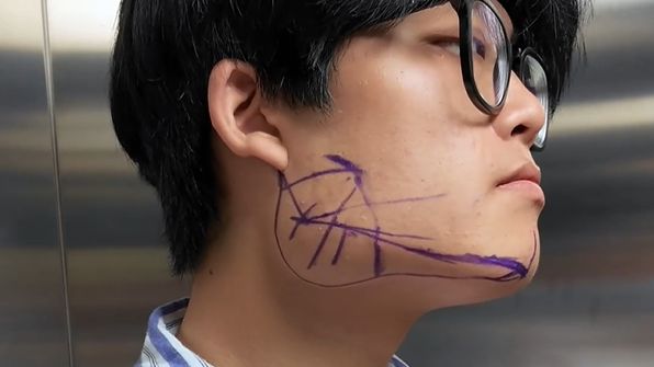 【邱立东】189男孩来做下颌角：身边嘲讽的声音，变成他改变的动力......