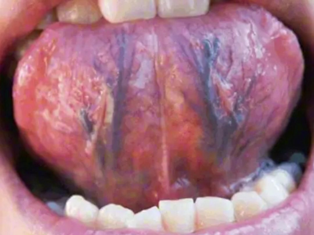 舌下静脉又黑又粗 到底是什么原因