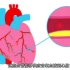 TED科教  心脏病时人体的变化