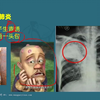 内科学呼吸系统高频考点（五）——肺炎