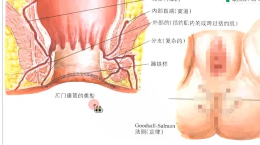 高位和低位肛瘘及其治疗