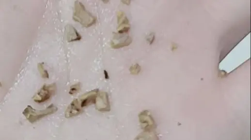 超详细的去除牙结石过程现在公布！进来学过来人的方法！