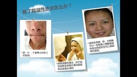 什么是青春痘视频 e2416fa973650829ac8710ae8e9fd00af0c020d6.jpg@280w_158h_1c_100q.jpg