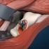 3D医学演示：股骨头坏死，人工髋关节置换手术全过程