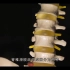 脊椎滑脱症与物理治疗