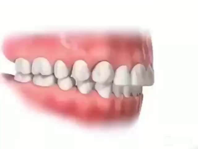 前牙深覆盖是什么情况